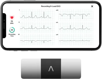 KardiaMobile 6 Six-Lead EKG Monitor (Detects AFib & Irregular Arrhythmias)