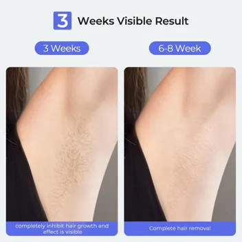 LUBEX Painless Ice Cooling IPL Laser Hair Removal Device and Men Permanent, Unlimited Flashes